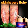 Targeted Eczema Treatment Cream