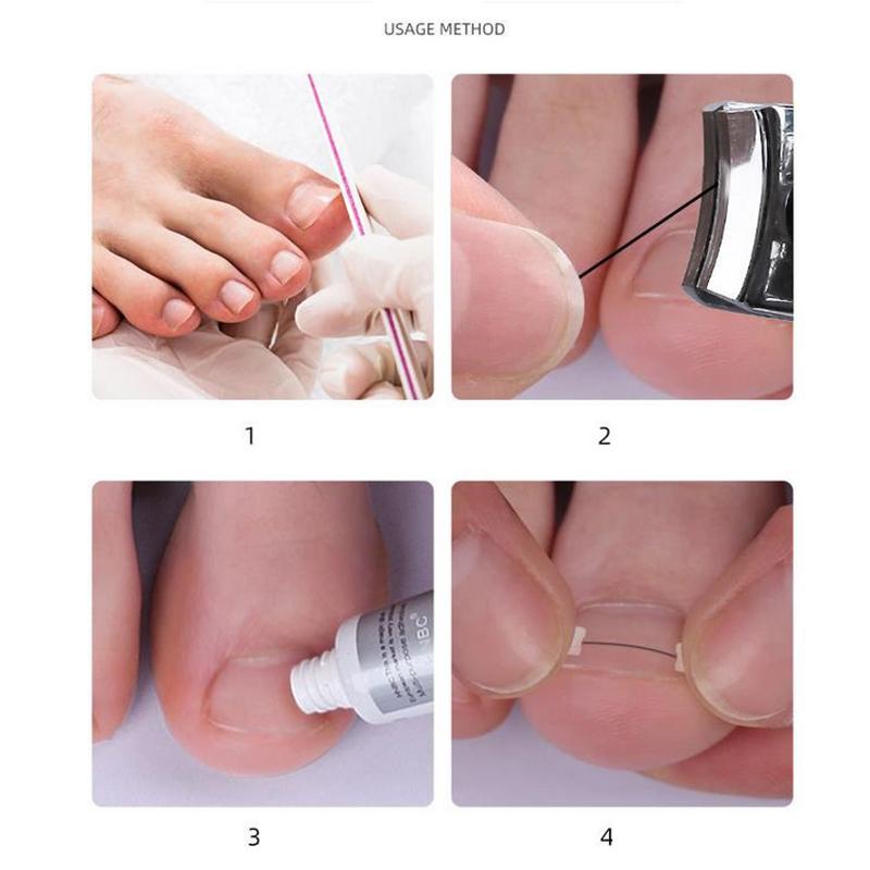 Ingrown Toenail Corrector Tools Pedicure Recover Embed Toe Nail Treatment Professional Ingrown Toenail Correction Foot Care