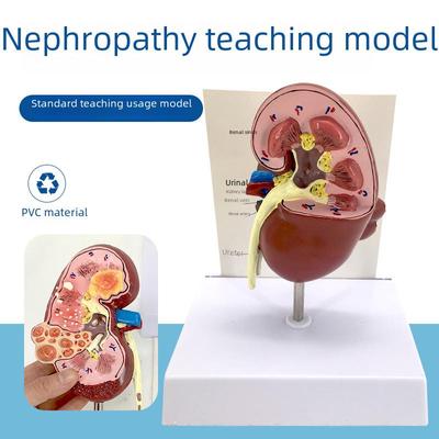 Патологическая анатомическая модель почки человека - Учебное пособие по мочевыделительной системе