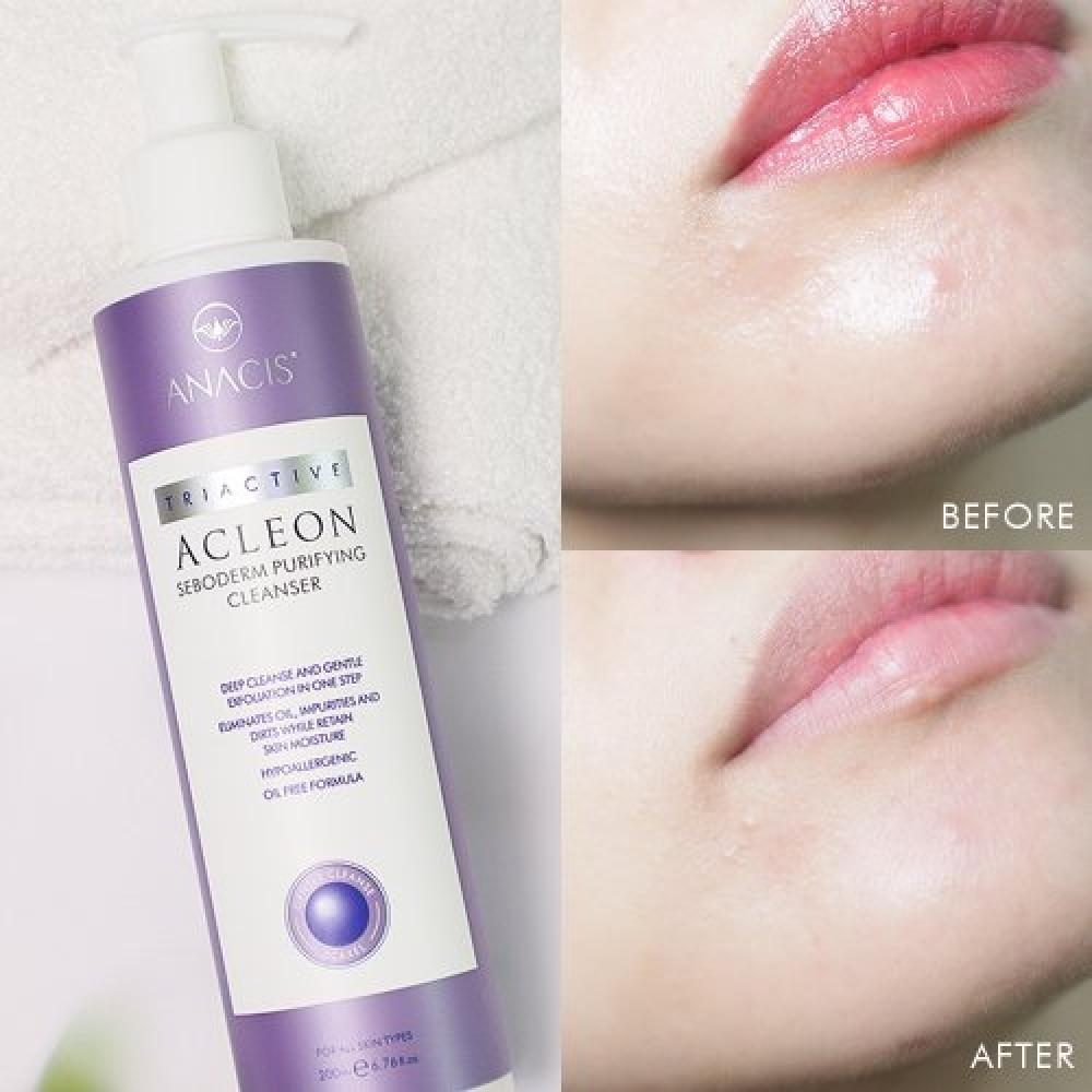 Acleon Anasis Acleon Mildly Alkaline Cleansing Foam 200ml