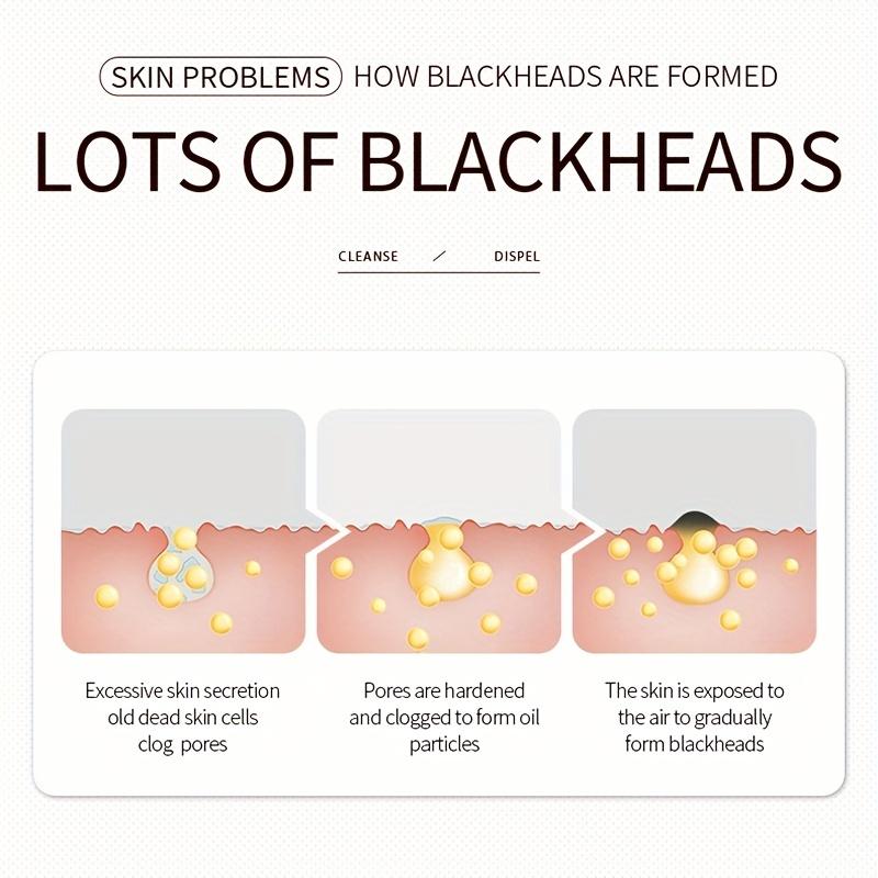 Удалить черные точки трехшаговый носовой стержень изогнутый носовой пластырь 7г x 3шт