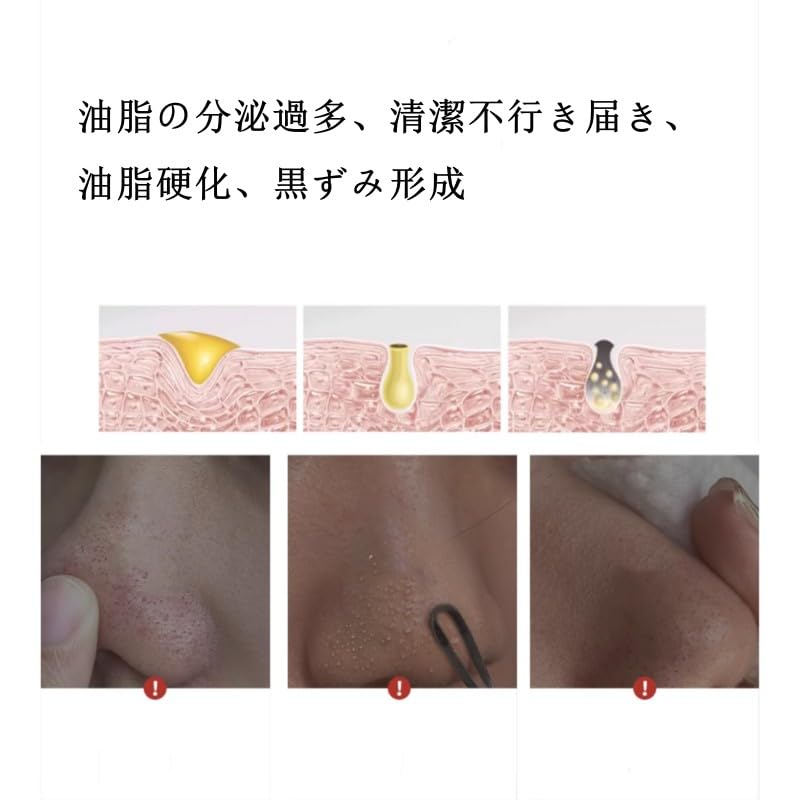 2 Pieces Stainless Steel Acne Nose Pore Cleaning Metal Pore Facial Massage Beauty Blackhead Cleaning Ideal for Women Spatula, Tool, Extractor, Tool,