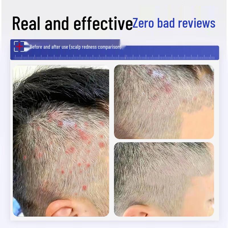 BEAI Selenium Sulfide Anti-Dandruff Shampoo