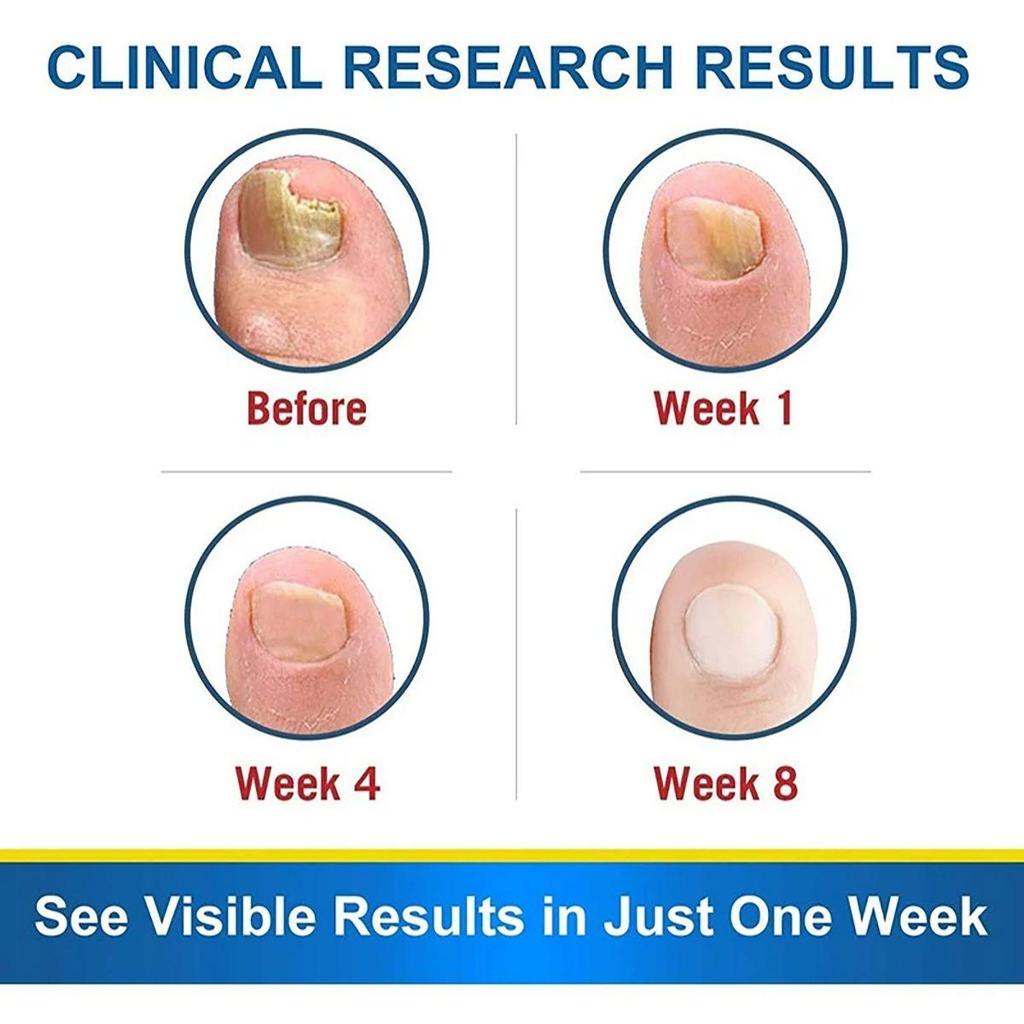 Средство для восстановления ногтей Onycho для рук и ног, подавляющее утолщение ногтей