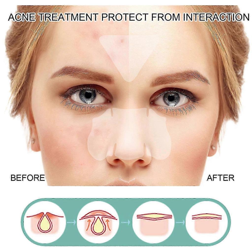 Acne Patch, Gentle and Non-irritating Facial Pores, Skin Cleaning and Comfortable Care Patch High Quality less