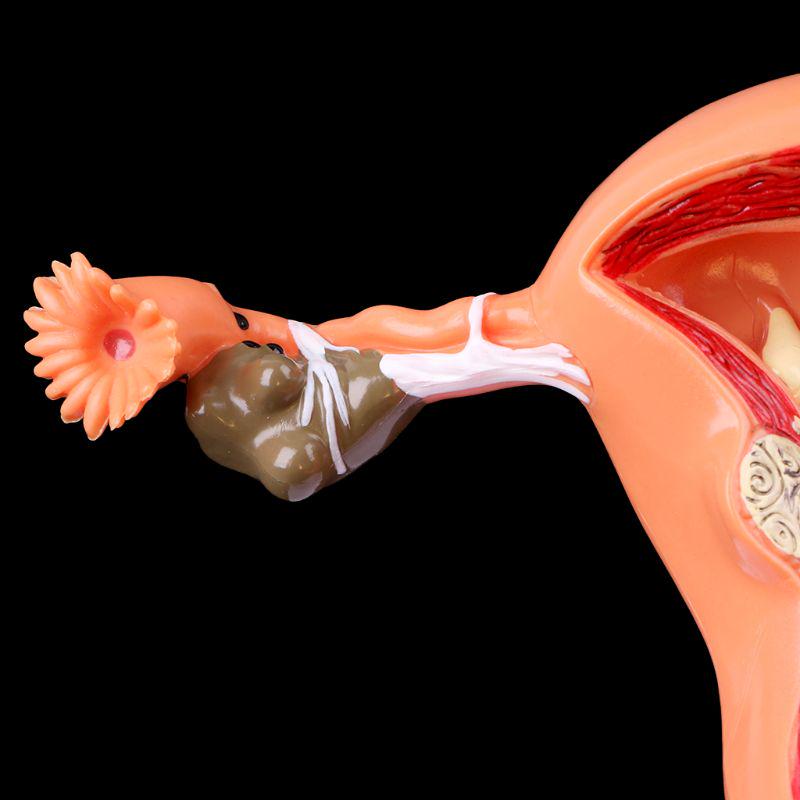 Pathological Uterus Ovary Anatomical Model Anatomy Cross Section Study Tool