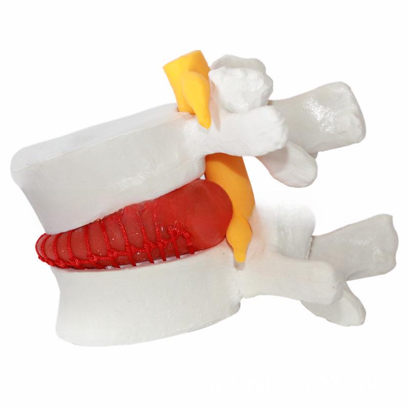 Подлинная модель протрузии поясничного отдела позвоночника и патологии позвонка