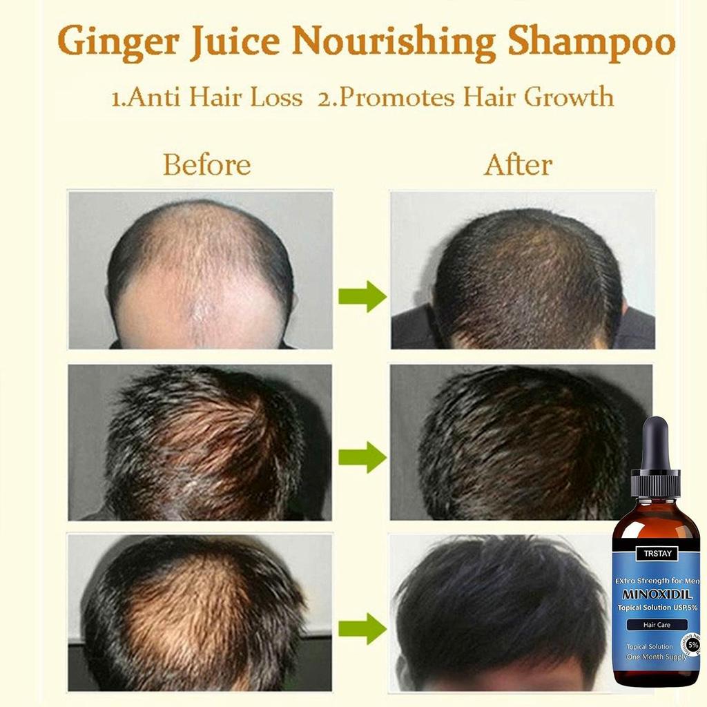 Африка Дикий Имбирь Эфирное масло для роста волос Сумасшедшее истончение пятен Выпадение краев волос Тяга волос Волосы Алопеция Предотвращение K3X4