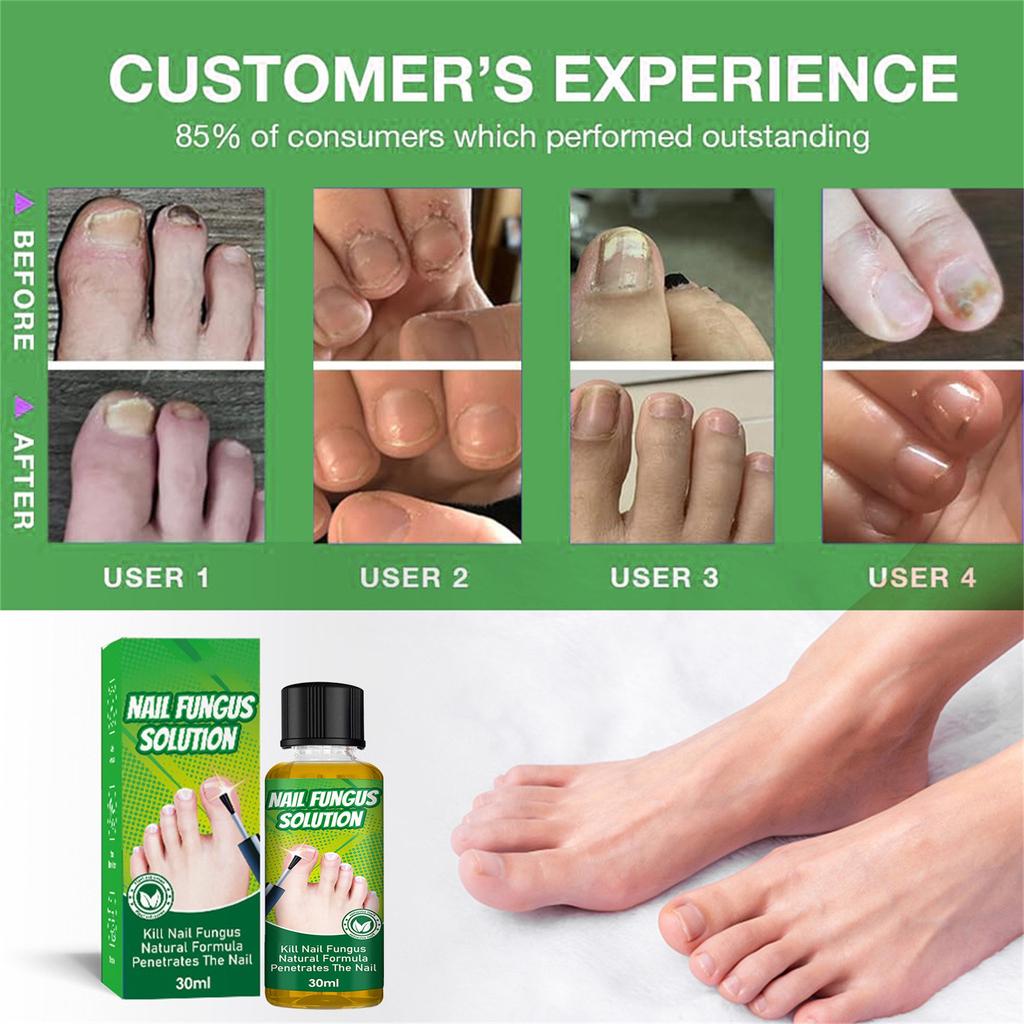 Toenail Fungus Care, FastActing Nail Care Liquid For Fungus Under & Around Restores The Healthy Appearance Of Nails 30ml