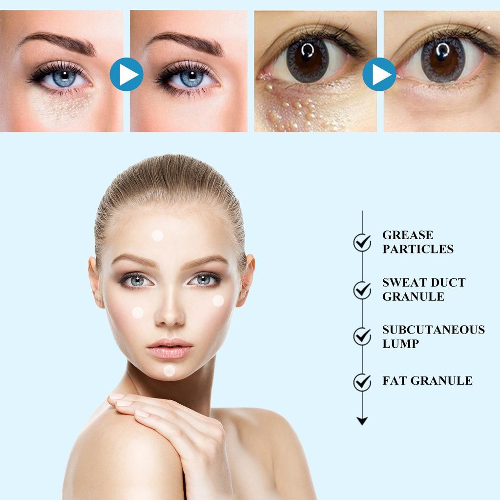 Пластырь с жировыми гранулами, удаление гранул масла с лица, подкожных комков, плоский пластырь для восстановления гранул потовой трубки