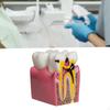 6 Times Caries Tooth Model Resin Structure Detailed Teaching Aid Decay Comparative
