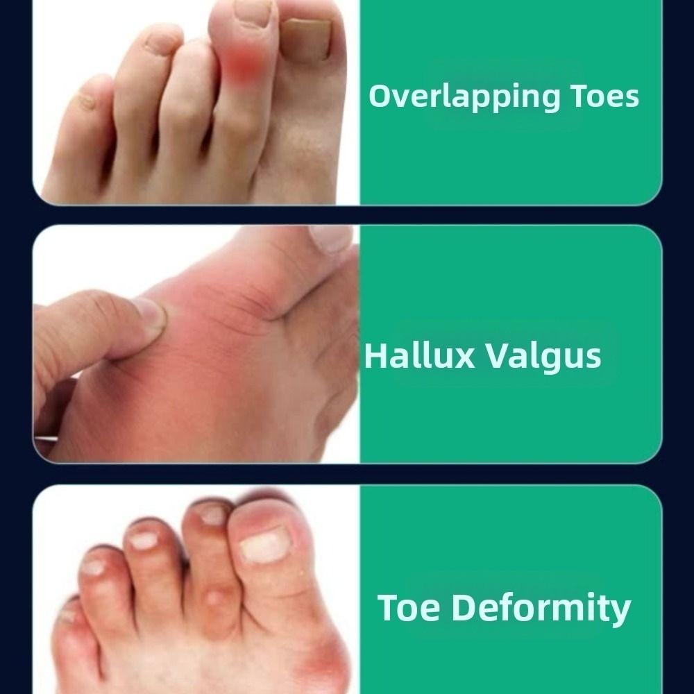 Adjustable Bunion Corrector Band Metal Reinforcement Foot Correction Brace  Outdoor