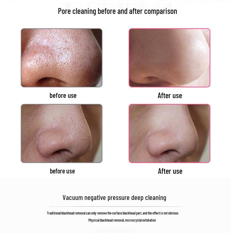 Горячая Распродажа Набор для Удаления Черных Точек и Очищения Пор