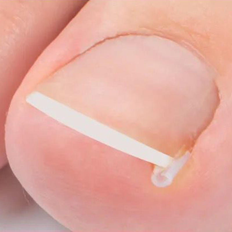 Набор из 50 шт. корректирующих подушечек для вросшего ногтя, ортез для ногтя, корректирующие полоски, бандаж для женщин и мужчин