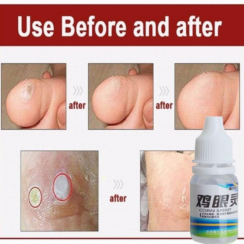 Мощное средство для удаления мозолей на ногах. Полезная жидкость для удаления мозолей на ногах. 10 мл.