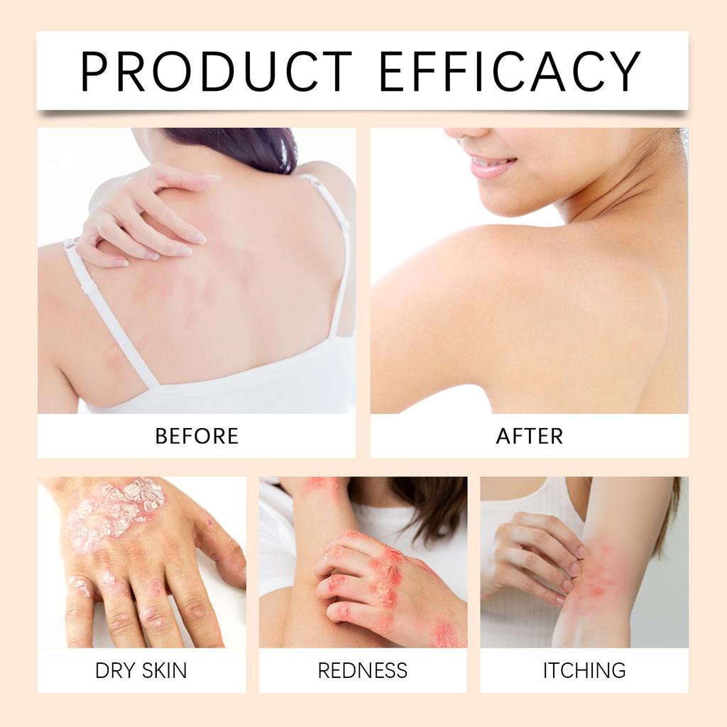 Крем для ухода за кожей для облегчения псориаза - банка 50 г от покраснения и раздражения