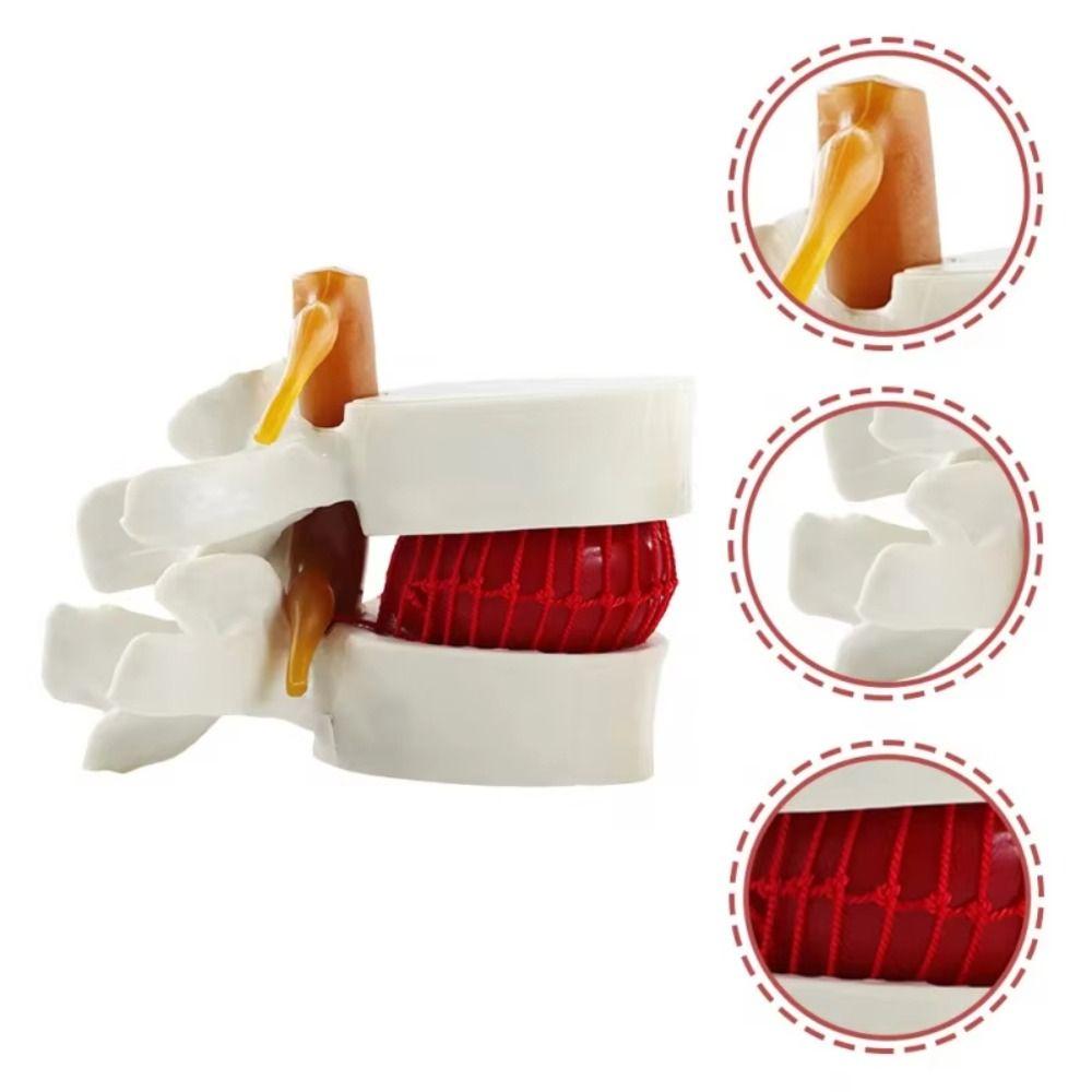 3D Model Lumbar Model 1.5X Enlarge Lumbar Disc Herniation Teaching Tool Nursing