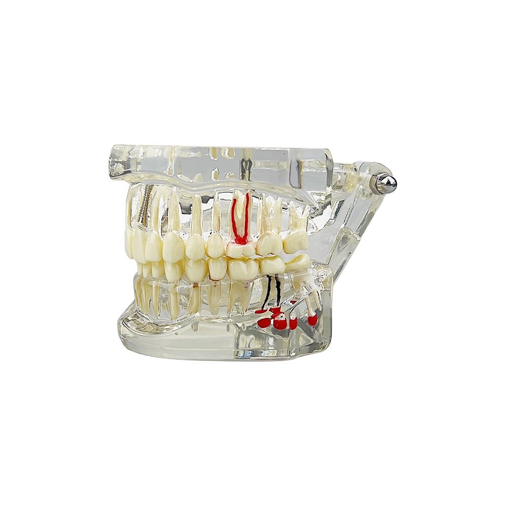 Teeth Model Implant Disease Dentist Studying Model With Restoration Bridge Tooth Demonstration Models For Patient Education