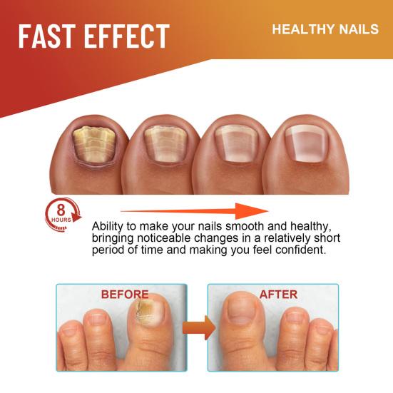 32 Pcs/Bag Toe Care Patches Safe Gentle Nail Fungus Relief Improve Nail Appearance Strengthen Nails Night Fungus Nail Patches