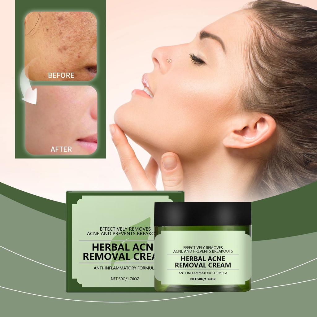 Крем для лица от прыщей, для лица и точек прыщей, натуральные растительные ингредиенты профессионально удаляют следы от прыщей, для подростков