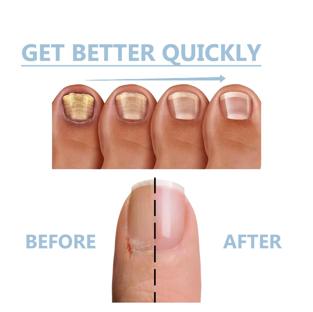 15 мл потрескавшихся ногтей, укрепитель ногтей для поврежденных ногтей, желтый ноготь на ногах, средство для укрепления и роста ногтей, набор для ногтей для потрескавшихся ногтей Natura