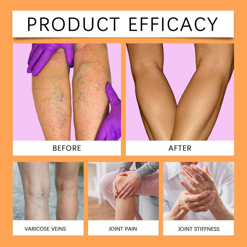 Кремы от боли в суставах уменьшают варикозное расширение вен, увеличивают подвижность суставов и стимулируют кровообращение