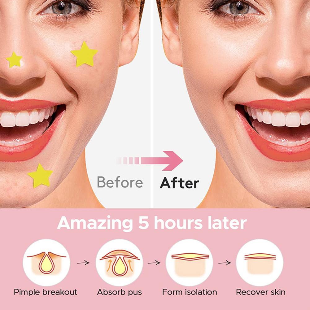 Красочные милые звезды сердечки патчи от прыщей, наклейки-покрытия, невидимые наклейки для маскировки прыщей на лице