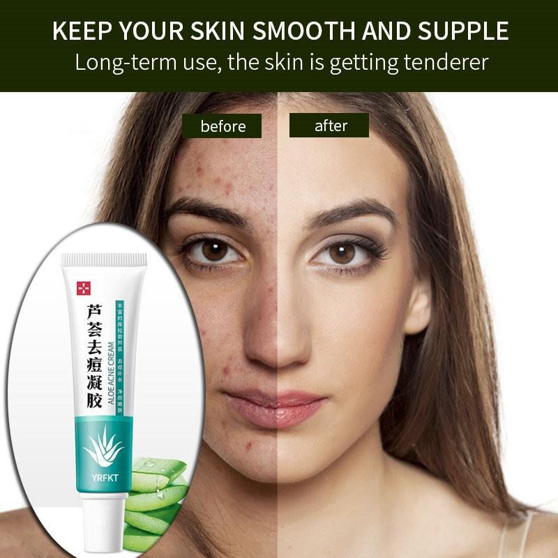 Крем против прыщей с экстрактом алоэ вера, крем для сна, сужающий поры