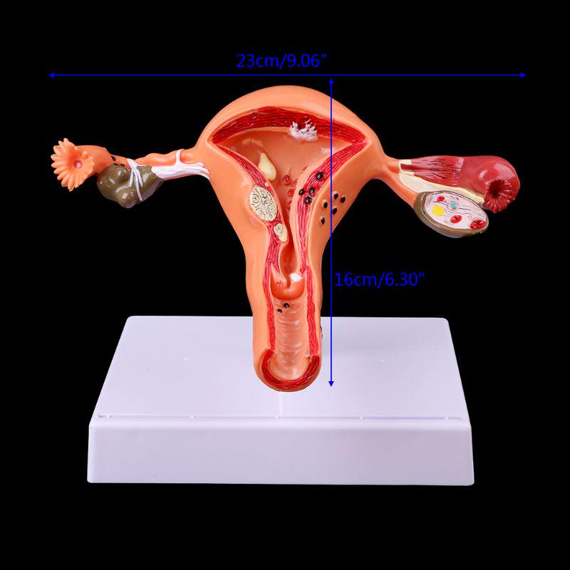 Pathological Uterus Ovary Anatomical Model Anatomy Cross Section Study Tool