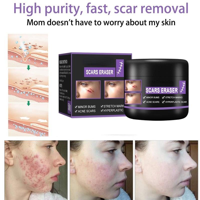 Крем для восстановления рубцов, обессоливание послеоперационных шрамов, гладкая кожа, восстановление кожных ран, увлажняющий крем для ухода за кожей