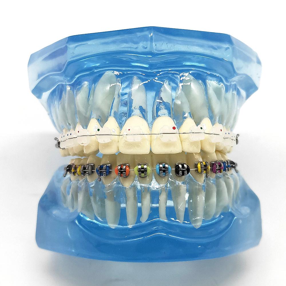 1 шт., стоматологическая ортодонтическая модель, связь с пациентом, 2 вида брекетов с дугами, лигатуры, керамический брекет, металлический краевой брекет
