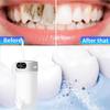 Water Flosser 5-Mode Oral Irrigator With 5 Nozzles 300 Ml Water Tank, IPX7 Waterproof, Home And Travel Water Flosser