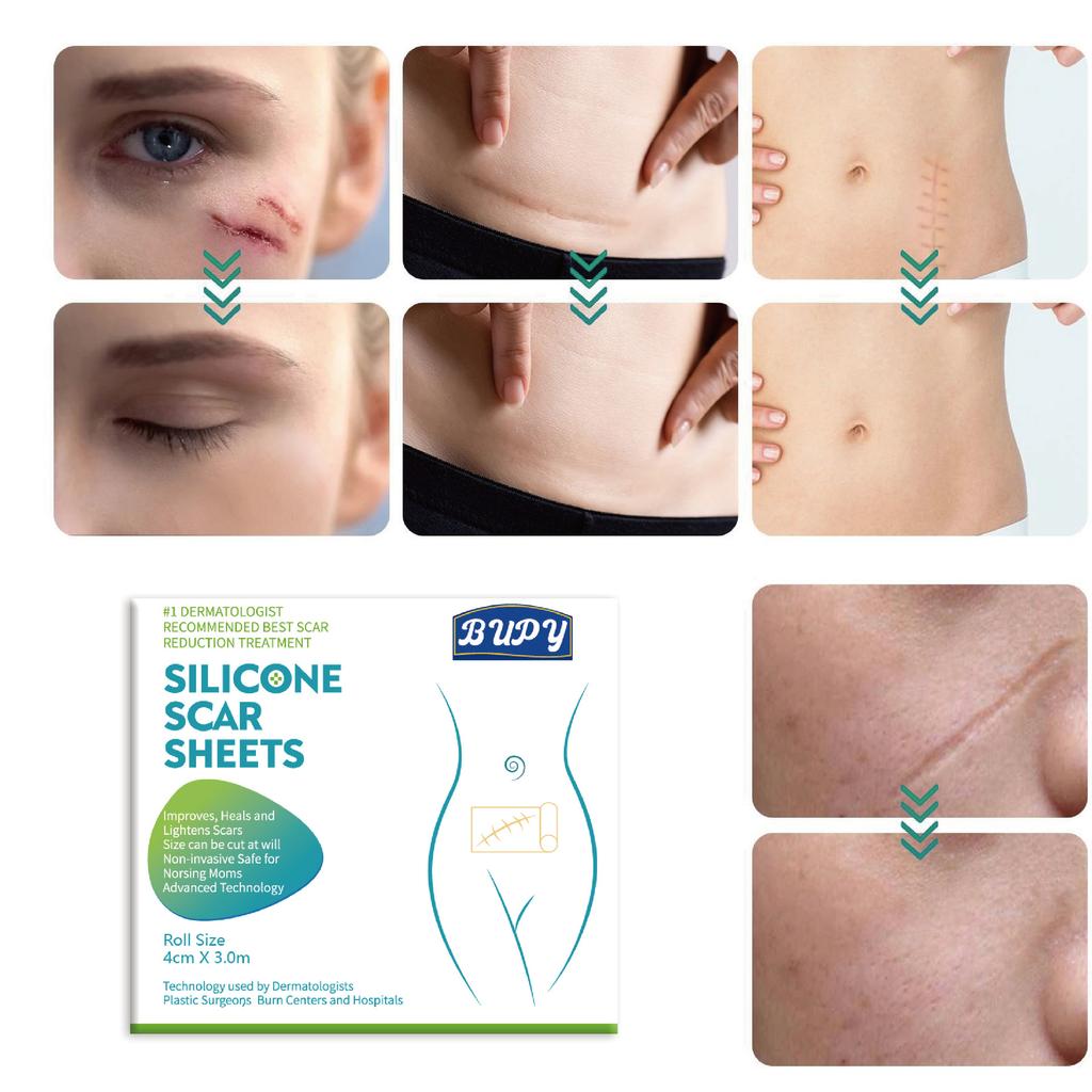 1 шт. 150 см силиконовый гелевый пластырь для лечения шрамов лента для удаления акне травма ожог шрам покрытие для восстановления кожи раздел ухо красота