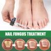 30ml Nail Repaird Solution, FootNail Tea-Tree Oil, Thick And Soft Nail Nutrition Hand And Foot Nail Care Solution