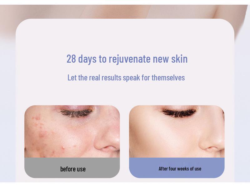 Озоновая плазма для удаления акне и стерилизации, косметический прибор: Омолаживает, подтягивает и восстанавливает кожу лица, при этом уничтожая клещей для домашнего использования.