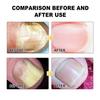 Nail Fungus Cleaning Device with Infrared Blue Light Therapy Home Use Nail-Fungus Remover for Toenail Fingernails Onychomycosis