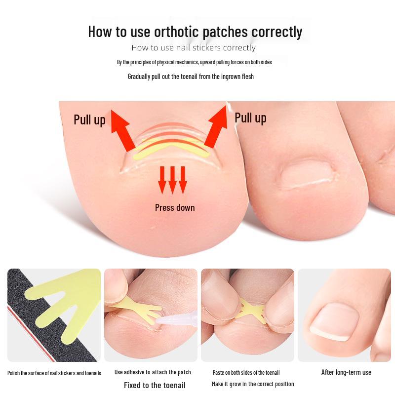 Звездообразный пластырь для коррекции вросшего ногтя