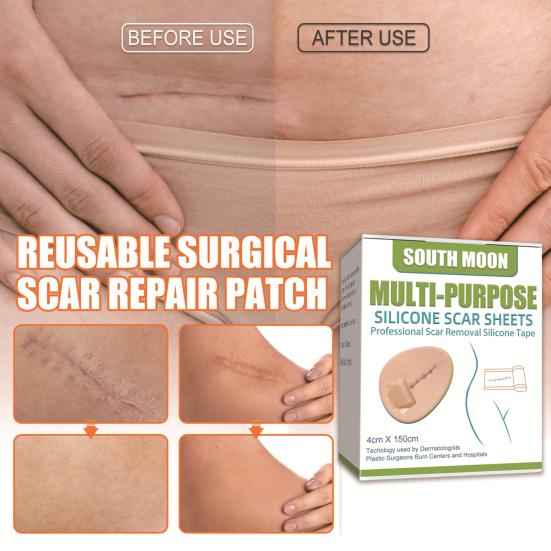 Эффективная наклейка на шрам, умеренный самоклеящийся безопасный силиконовый лист для ремонта шрамов, здравоохранение