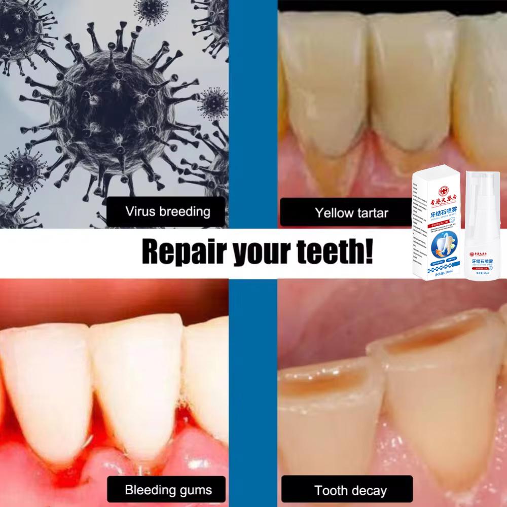 Спрей для удаления зубного камня для отбеливания зубов и удаления зубного налета