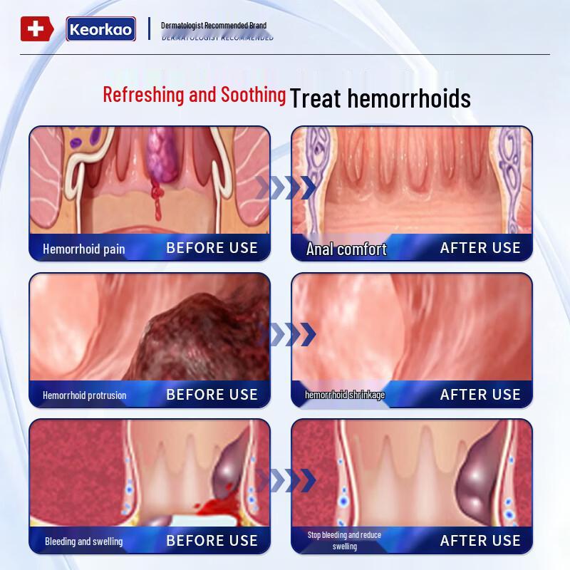 Hemorrhoid Relief Gel