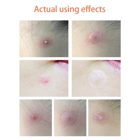 2 Packs Tea Tree Oil Day Night Acne Pimple Remover Patches Skin Care Treatment