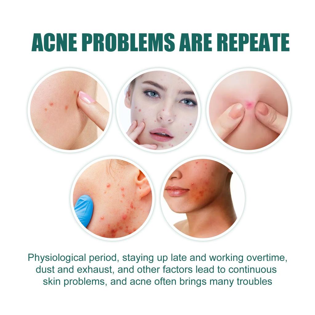 112pcs Invisible Acne Removal Pimple Patch Cute Star Shaped for Face Healing