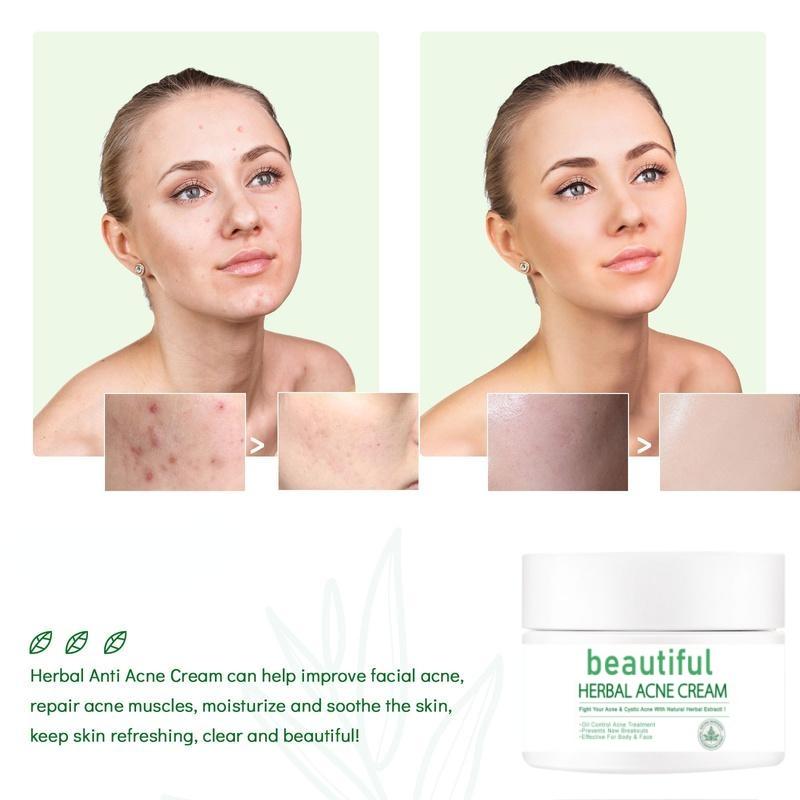 Acne Removing Cream, Acne Removing, Male and Female Students Fade Acne Marks, Acne Scar Removing Cream, Acne Pit Repairing