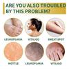 2pcs Vitiligo Skin Repair Cream,Vitiligo Treatment Cream, Dispose of White Spots on Skin and Improve Skin Pigmentation
