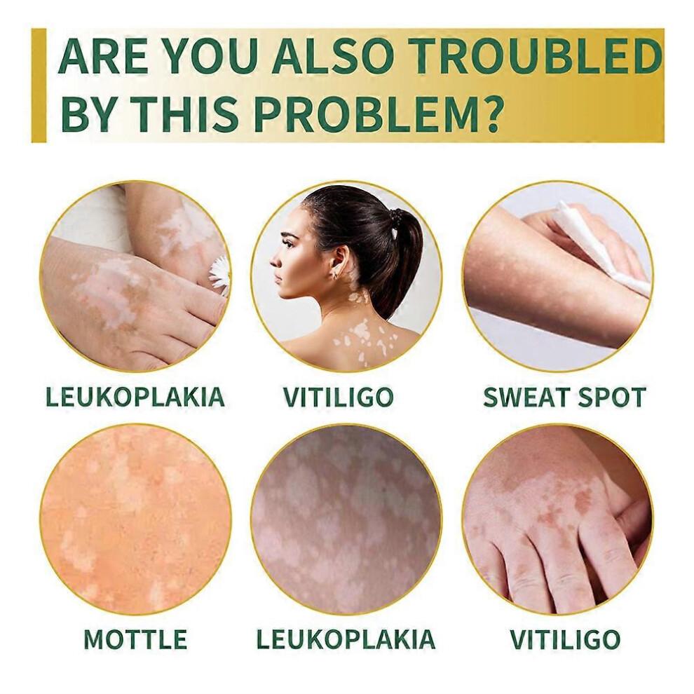 2pcs Vitiligo Skin Repair Cream,Vitiligo Treatment Cream, Dispose of White Spots on Skin and Improve Skin Pigmentation