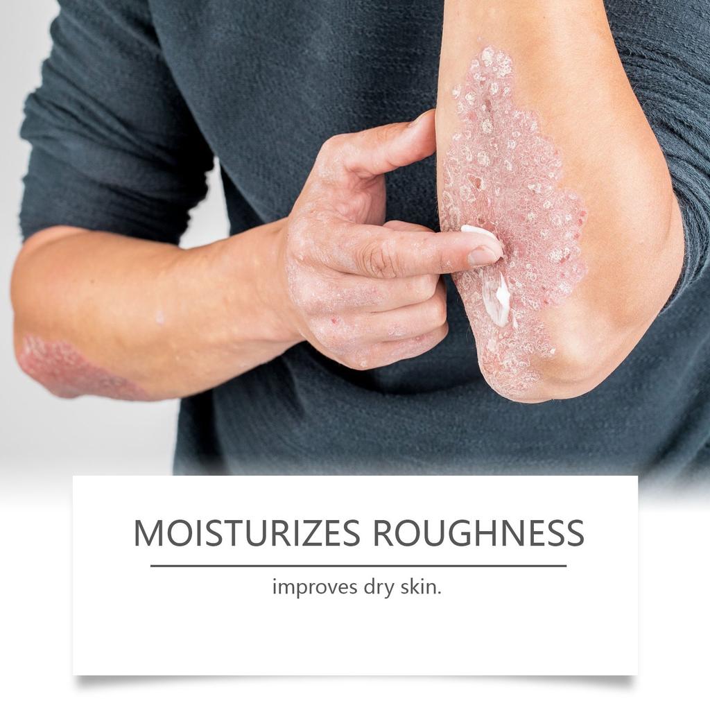 Увлажняющий крем для кожи снимает дискомфорт, увлажняет сухую кожу и поддерживает кожный барьер