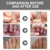Ximonth Nail Repair Cream For Gray Nails  Repairs And Brightens Nails, Treats Ingrown And Rotting Toenails, Thickened Nails, And Nail Groove Care