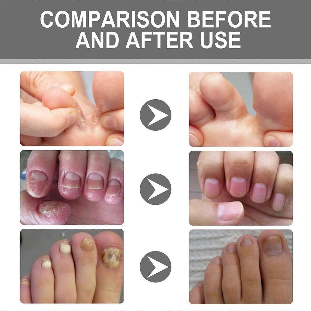 Ximonth Nail Repair Cream For Gray Nails  Repairs And Brightens Nails, Treats Ingrown And Rotting Toenails, Thickened Nails, And Nail Groove Care