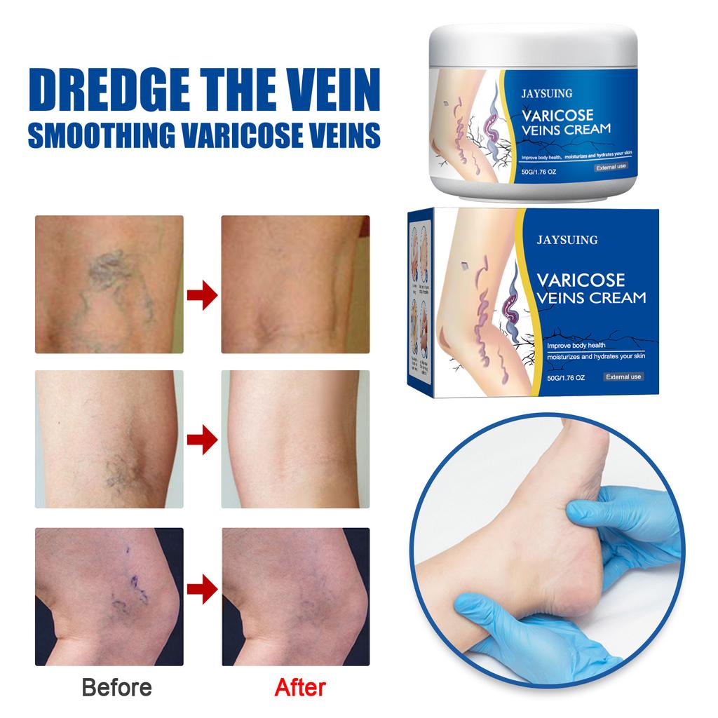 High-Efficacy Leg Vein Repair Cream Varicose Massage Cream for Earthworm Leg, Activate Meridians and Alleviate Pain and Swelling