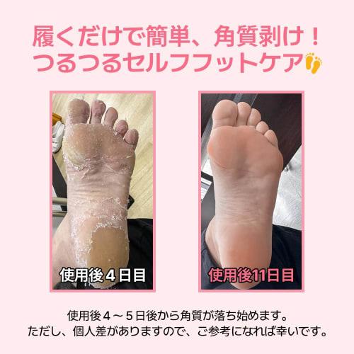 MADFORCOS Silky Smooth Foot Peeling Mask, 40ml, 2 Sheets, Painless Heel Callus Removal, Foot Exfoliation Mask